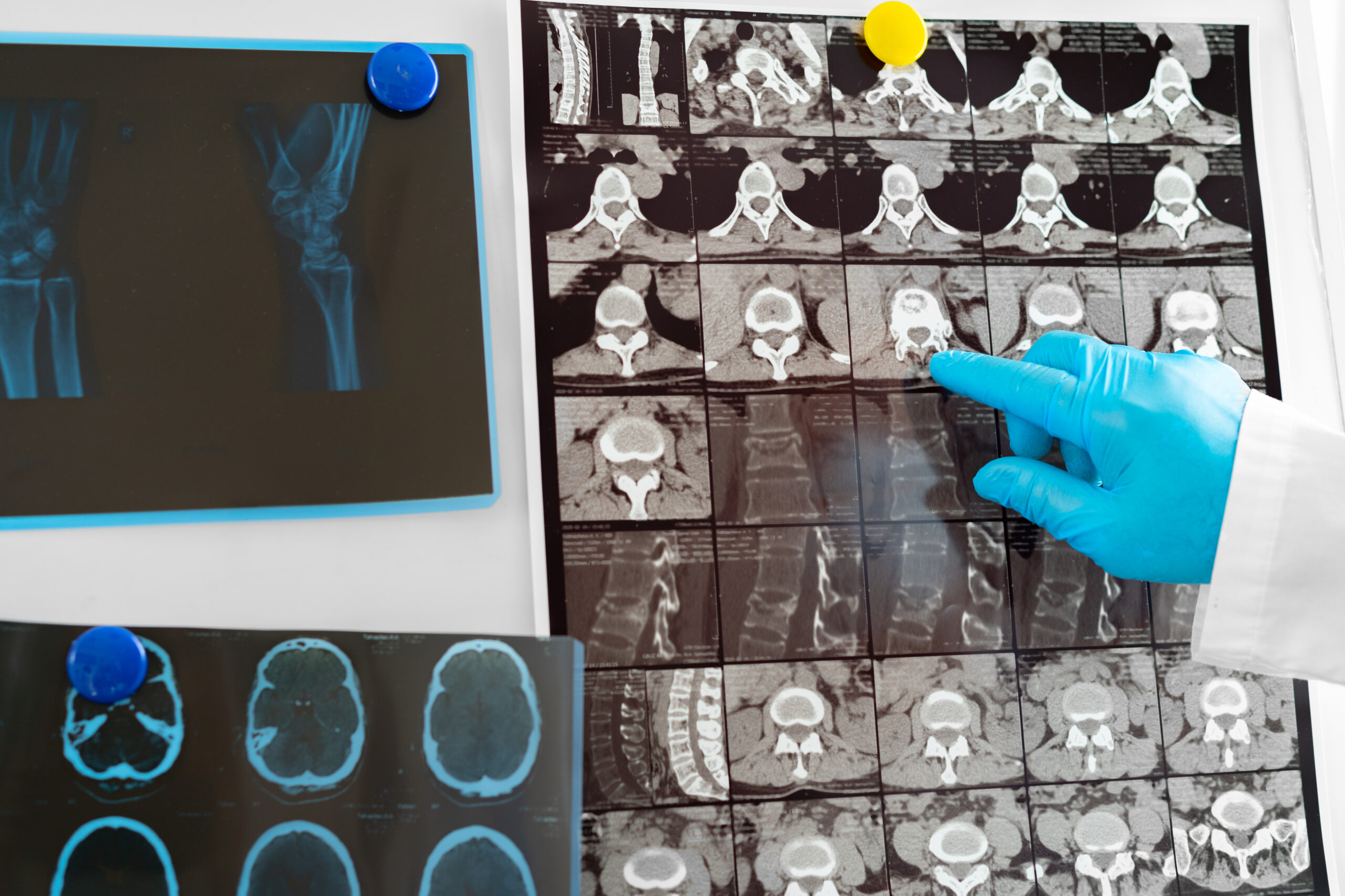 Joint Replacement Surgery – What You Need to Know